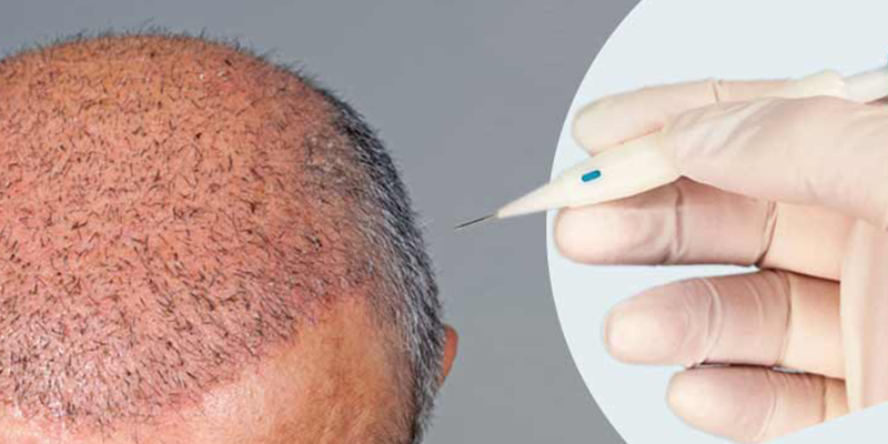 DHI: Direct Hair Implantation