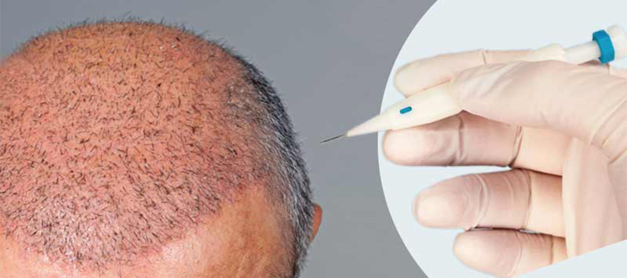 DHI  Direct hair implantation  Espoir Clinic